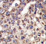 Formalin-fixed and paraffin-embedded human hepatocarcinoma tissue reacted with MTMR4 antibody , which was peroxidase-conjugated to the secondary antibody, followed by DAB staining. This data demonstrates the use of this antibody for immunohistochemistry; clinical relevance has not been evaluated.