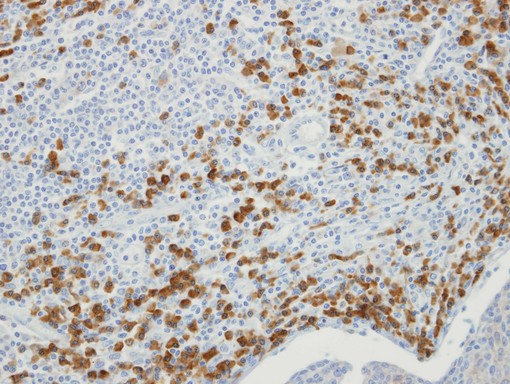 IHC of paraffin-embedded SCC xenograft using MTMR9 antibody at 1:100 dilution.