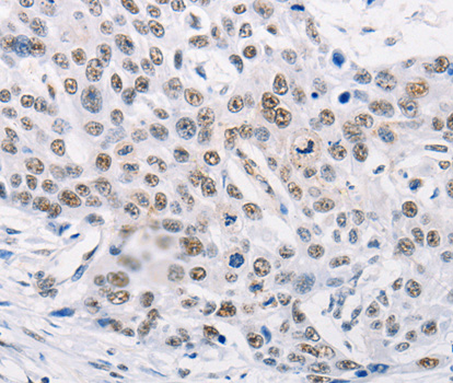 Immunohistochemistry of paraffin-embedded human esophagus cancer tissue using TRIM63 antibody.