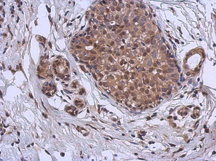 IHC of paraffin-embedded Breast ca using MURF1 antibody at 1:500 dilution.