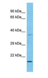MXD3 / MAD3 antibody Western Blot of Esophagus Tumor. Antibody dilution: 1 ug/ml.
