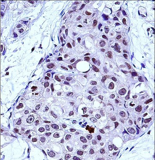 MYB Antibody immunohistochemistry of formalin-fixed and paraffin-embedded human breast carcinoma followed by peroxidase-conjugated secondary antibody and DAB staining.