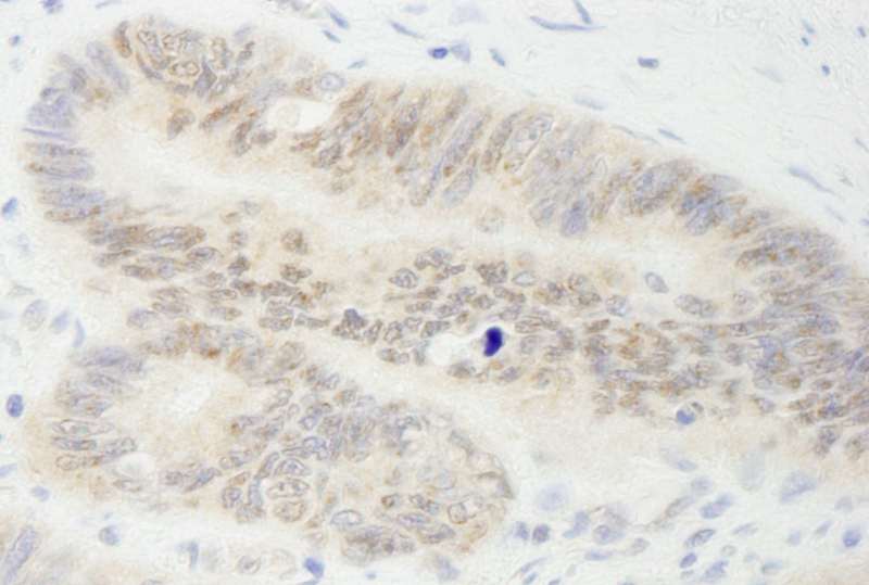 Detection of Human MYBBP1a by Immunohistochemistry. Sample: FFPE section of human colon carcinoma. Antibody: Affinity purified rabbit anti-MYBBP1a used at a dilution of 1:1000 (1 ug/ml). Detection: DAB.