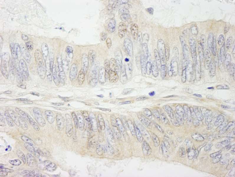 Detection of Human MYBBP1a by Immunohistochemistry. Sample: FFPE section of human colon carcinoma. Antibody: Affinity purified rabbit anti-MYBBP1a used at a dilution of 1:250.