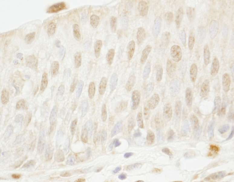 Detection of Human MYBBP1a by Immunohistochemistry. Sample: FFPE section of human bladder cell carcinoma. Antibody: Affinity purified rabbit anti-MYBBP1a used at a dilution of 1:250.