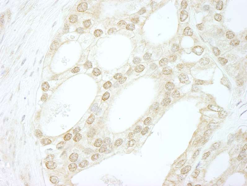 Detection of Human B-Myb by Immunohistochemistry. Sample: FFPE section of human prostate carcinoma. Antibody: Affinity purified rabbit anti-B-Myb used at a dilution of 1:250.