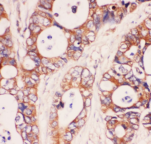 MyD88 antibody IHC-paraffin: Human Intestinal Cancer Tissue.