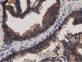 IHC of paraffin-embedded Carcinoma of Human prostate tissue using anti-MYD88 mouse monoclonal antibody.