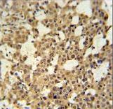 CJ119 Antibody immunohistochemistry of formalin-fixed and paraffin-embedded human cervix carcinoma tissue followed by peroxidase-conjugated secondary antibody and DAB staining.