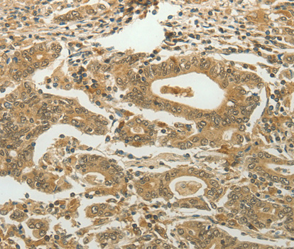 Immunohistochemistry of paraffin-embedded human gastric cancer tissue using MYSM1 antibody.