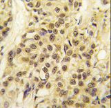 Formalin-fixed and paraffin-embedded human breast carcinoma tissue reacted with HMOF/MYST1 antibody , which was peroxidase-conjugated to the secondary antibody, followed by DAB staining. This data demonstrates the use of this antibody for immunohistochemistry; clinical relevance has not been evaluated.