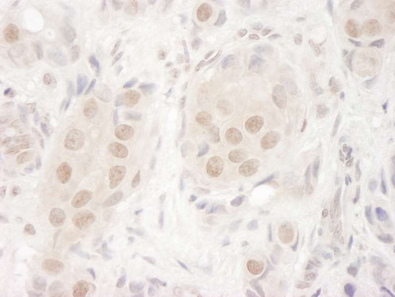 Detection of Human MOF/MYST1 by Immunohistochemistry. Sample: FFPE section of human breast carcinoma. Antibody: Affinity purified rabbit anti-MOF/MYST1 used at a dilution of 1:250. Epitope Retrieval Buffer-High pH (IHC-101J) was substituted for Epitope Retrieval Buffer-Reduced pH.