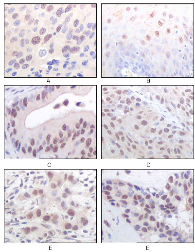 IHC of paraffin-embedded human esophageal squamous cell carcinoma (A), normal esophagus epithelium (B), rectum adenocarcinoma (C), lung squamous cell carcinoma (D), breast infiltrating carcinoma (E), and breast infiltrat