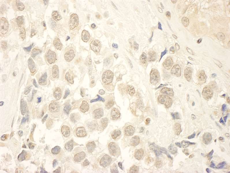 FFPE section of human testicular seminoma. LS-C286838 used at a dilution of 1:250.