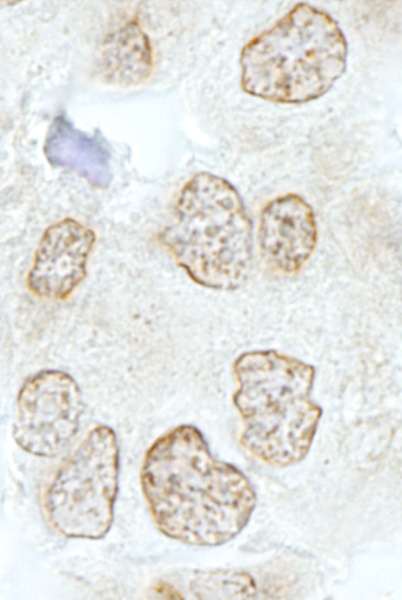 Detection of Human SSB1 by Immunohistochemistry. Sample: FFPE section of human colon carcinoma. Antibody: Affinity purified rabbit anti-SSB1 used at a dilution of 1:500.