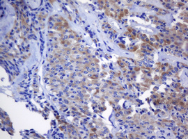 IHC of paraffin-embedded Carcinoma of Human thyroid tissue using anti-NANP mouse monoclonal antibody.