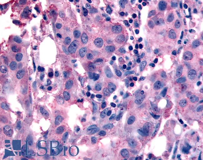 Anti-NANP antibody IHC of human Breast, Carcinoma. Immunohistochemistry of formalin-fixed, paraffin-embedded tissue after heat-induced antigen retrieval.