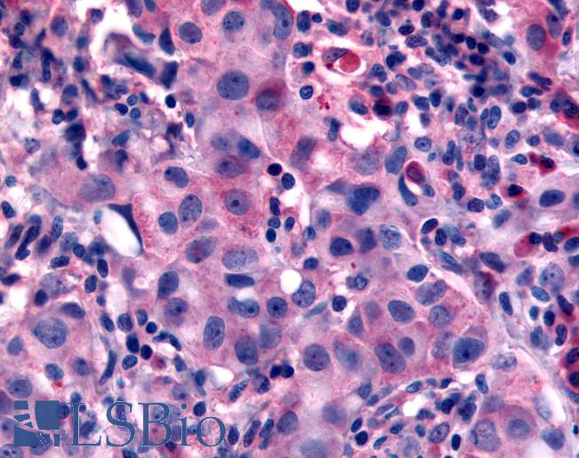 Anti-NANP antibody IHC of human Breast, Carcinoma. Immunohistochemistry of formalin-fixed, paraffin-embedded tissue after heat-induced antigen retrieval.