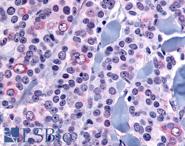 Anti-NANP antibody IHC of human Breast, Carcinoma. Immunohistochemistry of formalin-fixed, paraffin-embedded tissue after heat-induced antigen retrieval.