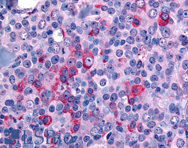 Anti-NANP antibody IHC of human Breast, Carcinoma. Immunohistochemistry of formalin-fixed, paraffin-embedded tissue after heat-induced antigen retrieval.
