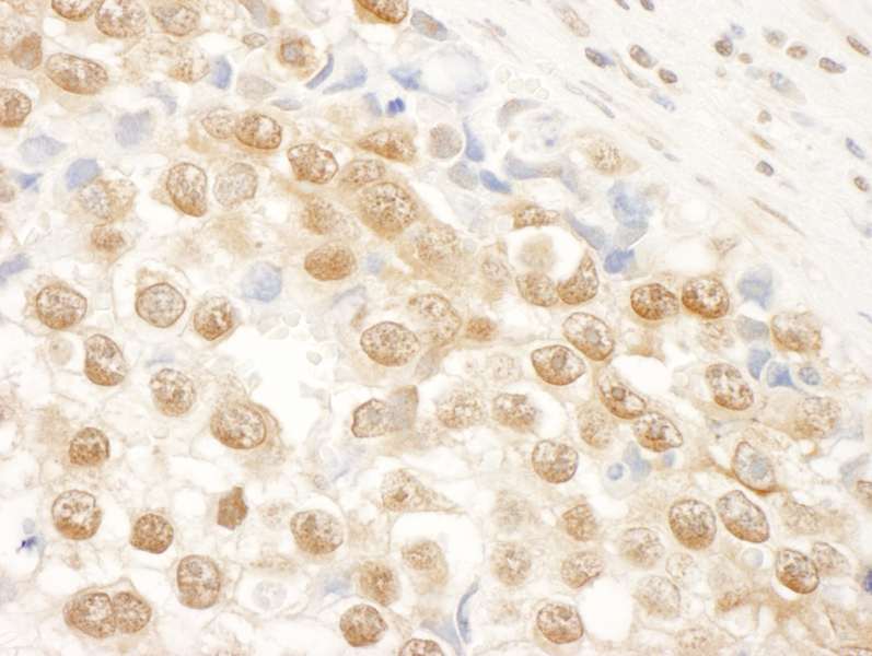 Detection of Human NARG1 by Immunohistochemistry. Sample: FFPE section of human testicular seminoma. Antibody: Affinity purified rabbit anti-NARG1 used at a dilution of 1:250.