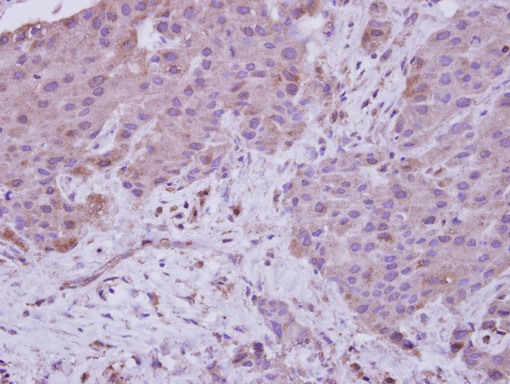 IHC of paraffin-embedded Breast ca, using NARG1 antibody at 1:250 dilution.