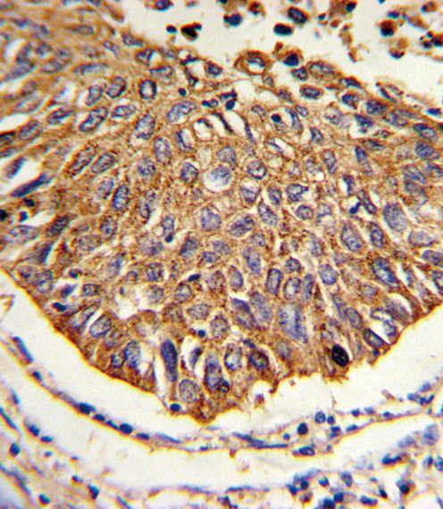 Formalin-fixed and paraffin-embedded human lung carcinoma reacted with MDH2 Antibody , which was peroxidase-conjugated to the secondary antibody, followed by DAB staining. This data demonstrates the use of this antibody for immunohistochemistry; clinical relevance has not been evaluated.