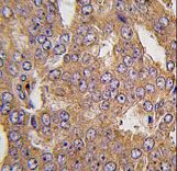 Formalin-fixed and paraffin-embedded human prostate carcinoma tissue reacted with NARS2 antibody , which was peroxidase-conjugated to the secondary antibody, followed by DAB staining. This data demonstrates the use of this antibody for immunohistochemistry; clinical relevance has not been evaluated.