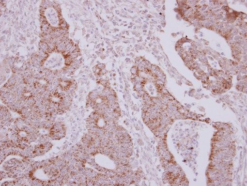 IHC of paraffin-embedded Colon ca, using NARS2 antibody at 1:250 dilution.