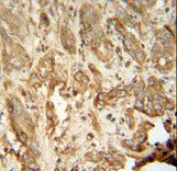 NAT14 antibody immunohistochemistry of formalin-fixed and paraffin-embedded human hepatocarcinoma followed by peroxidase-conjugated secondary antibody and DAB staining.