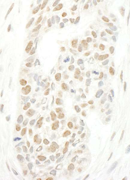 Detection of Human CAP-H2 by Immunohistochemistry. Sample: FFPE section of human skin carcinoma. Antibody: Affinity purified rabbit anti-CAP-H2 used at a dilution of 1:250.