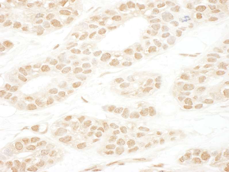 Detection of Human CAP-H2 by Immunohistochemistry. Sample: FFPE section of human breast carcinoma. Antibody: Affinity purified rabbit anti-CAP-H2 used at a dilution of 1:1000 (1 ug/ml).