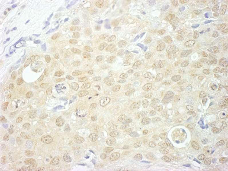 Detection of Human NCBP1/CBP80 by Immunohistochemistry. Sample: FFPE section of human breast carcinoma. Antibody: Affinity purified rabbit anti-NCBP1/CBP80 used at a dilution of 1:200 (1 ug/ml). Detection: DAB.