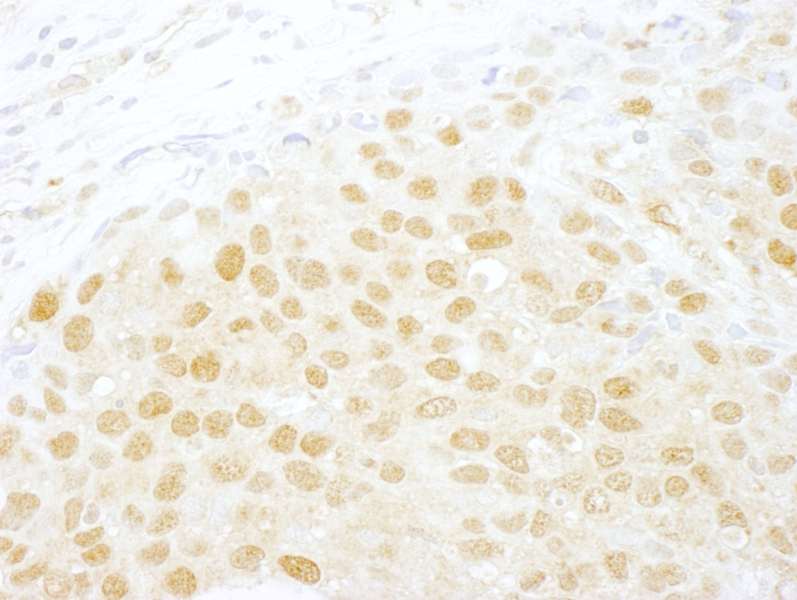 Detection of Human NCBP1/CBP80 by Immunohistochemistry. Sample: FFPE section of human breast carcinoma. Antibody: Affinity purified rabbit anti-NCBP1/CBP80 used at a dilution of 1:250.