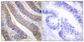 IHC of paraffin-embedded human colon carcinoma tissue, using p47 phox (Ab-359) Antibody. The picture on the right is treated with the synthesized peptide.