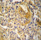 NCF1 Antibody immunohistochemistry of formalin-fixed and paraffin-embedded human lung carcinoma followed by peroxidase-conjugated secondary antibody and DAB staining.