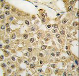 Formalin-fixed and paraffin-embedded human breast carcinoma tissue reacted with the MDM2 Antibody (S166) , which was peroxidase-conjugated to the secondary antibody, followed by DAB staining. This data demonstrates the use of this antibody for immunohistochemistry; clinical relevance has not been evaluated.