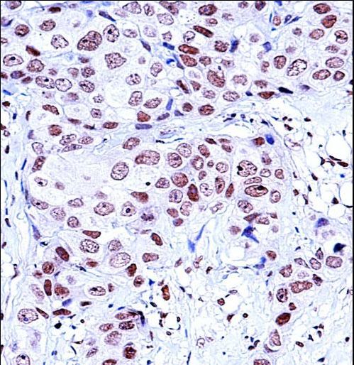 NCK1 Antibody immunohistochemistry of formalin-fixed and paraffin-embedded human breast carcinoma followed by peroxidase-conjugated secondary antibody and DAB staining.