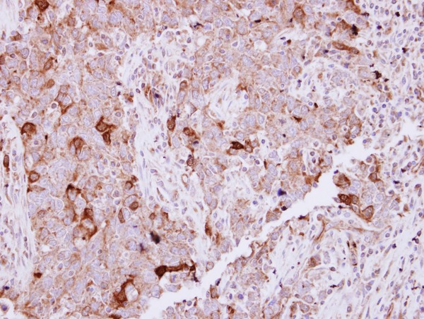 IHC of paraffin-embedded Lung Papillary Adenocarcinoma, using NCKAP1 antibody at 1:250 dilution.