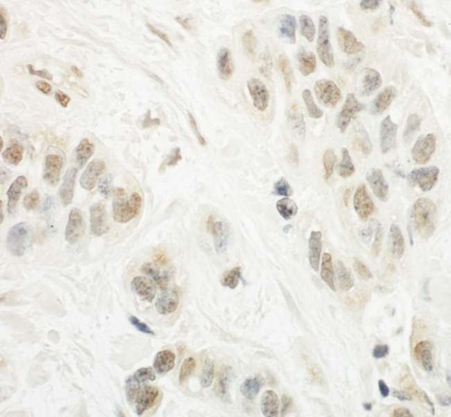 Detection of Human SPIN90 by Immunohistochemistry. Sample: FFPE section of human breast carcinoma. Antibody: Affinity purified rabbit anti-SPIN90 used at a dilution of 1:1000 (1 ug/ml). Detection: DAB.