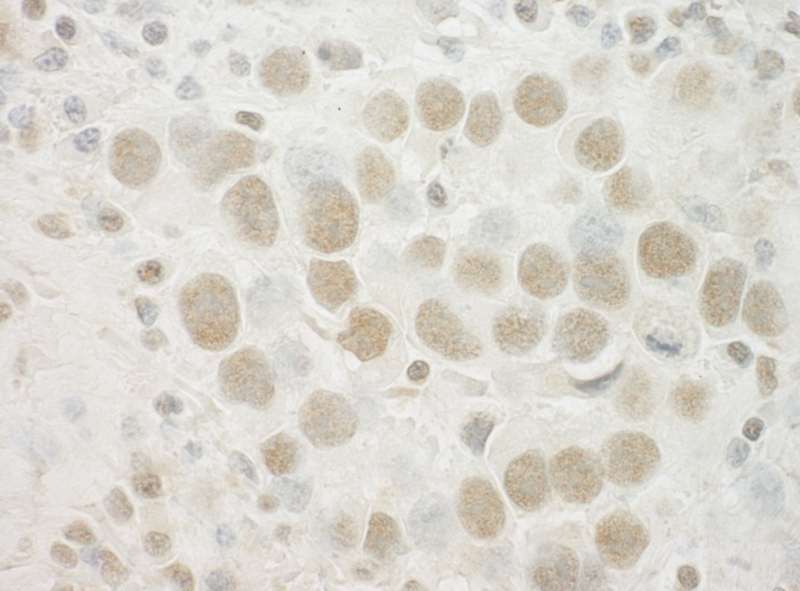 Detection of Human SPIN90 by Immunohistochemistry. Sample: FFPE section of human seminoma. Antibody: Affinity purified rabbit anti-SPIN90 used at a dilution of 1:250.
