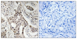 IHC of paraffin-embedded human breast carcinoma, using NCoA2 (Phospho-Ser736) Antibody. The sample on the right was incubated with synthetic peptide.