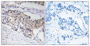 IHC of paraffin-embedded human breast carcinoma tissue, using NDUFA3 Antibody. The picture on the right is treated with the synthesized peptide.