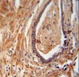 NDUFAF1 antibody immunohistochemistry of formalin-fixed and paraffin-embedded human prostate carcinoma followed by peroxidase-conjugated secondary antibody and DAB staining.