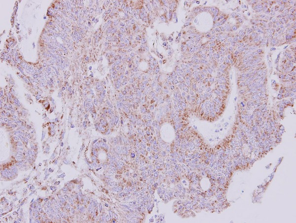 IHC of paraffin-embedded Colon ca using NDUFS1 antibody at 1:250 dilution.