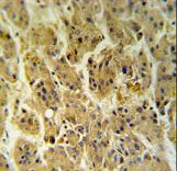 NDUFS2 Antibody IHC of formalin-fixed and paraffin-embedded hepatocarcinoma followed by peroxidase-conjugated secondary antibody and DAB staining.