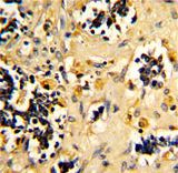 Formalin-fixed and paraffin-embedded human kidney carcinoma reacted with NDUFS4 Antibody , which was peroxidase-conjugated to the secondary antibody, followed by DAB staining. This data demonstrates the use of this antibody for immunohistochemistry; clinical relevance has not been evaluated.