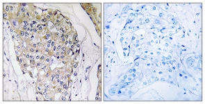 IHC of paraffin-embedded human breast carcinoma tissue, using NDUFS6 Antibody. The sample on the right was incubated with synthetic peptide.
