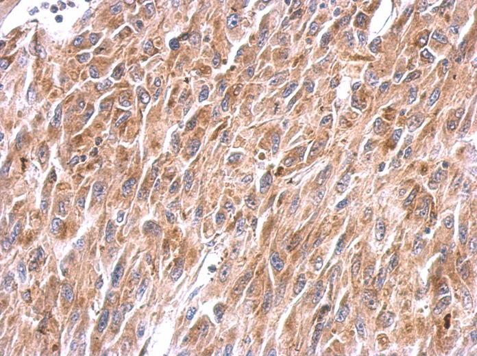 NDUFS8 antibody detects NDUFS8 protein at cytosol on U87 xenograft by immunohistochemical analysis. Sample: Paraffin-embedded U87 xenograft. NDUFS8 antibody dilution:1:500.