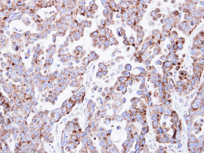 IHC of paraffin-embedded OVCAR3 xenograft using NDUFV2 antibody at 1:100 dilution.